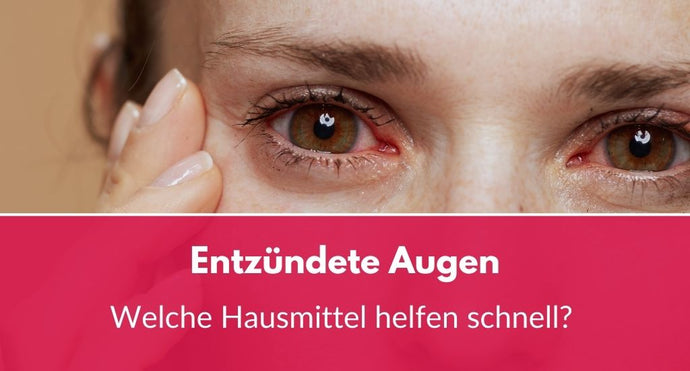 Entzündete Augen: Welche Hausmittel helfen schnell?